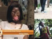 A Ghanaian Journalist's Documentary on Vitiligo covering Heikeens Enam