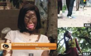 A Ghanaian Journalist's Documentary on Vitiligo covering Heikeens Enam A Ghanaian Journalist's Documentary on Vitiligo covering Heikeens Enam